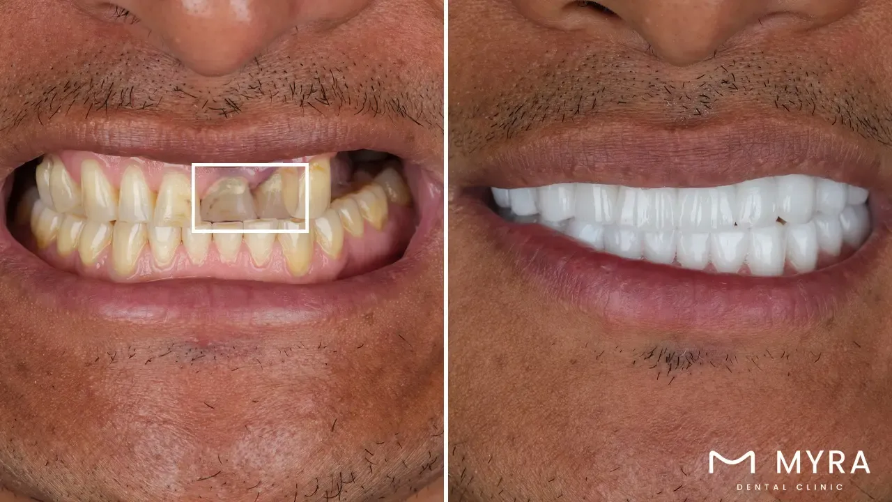 What is the alternative for Dental Implants_.webp